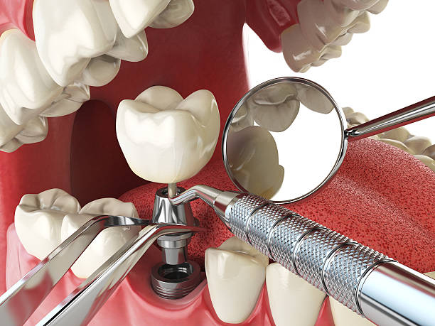 Best Broken or Chipped Tooth Repair in Great Falls, MT